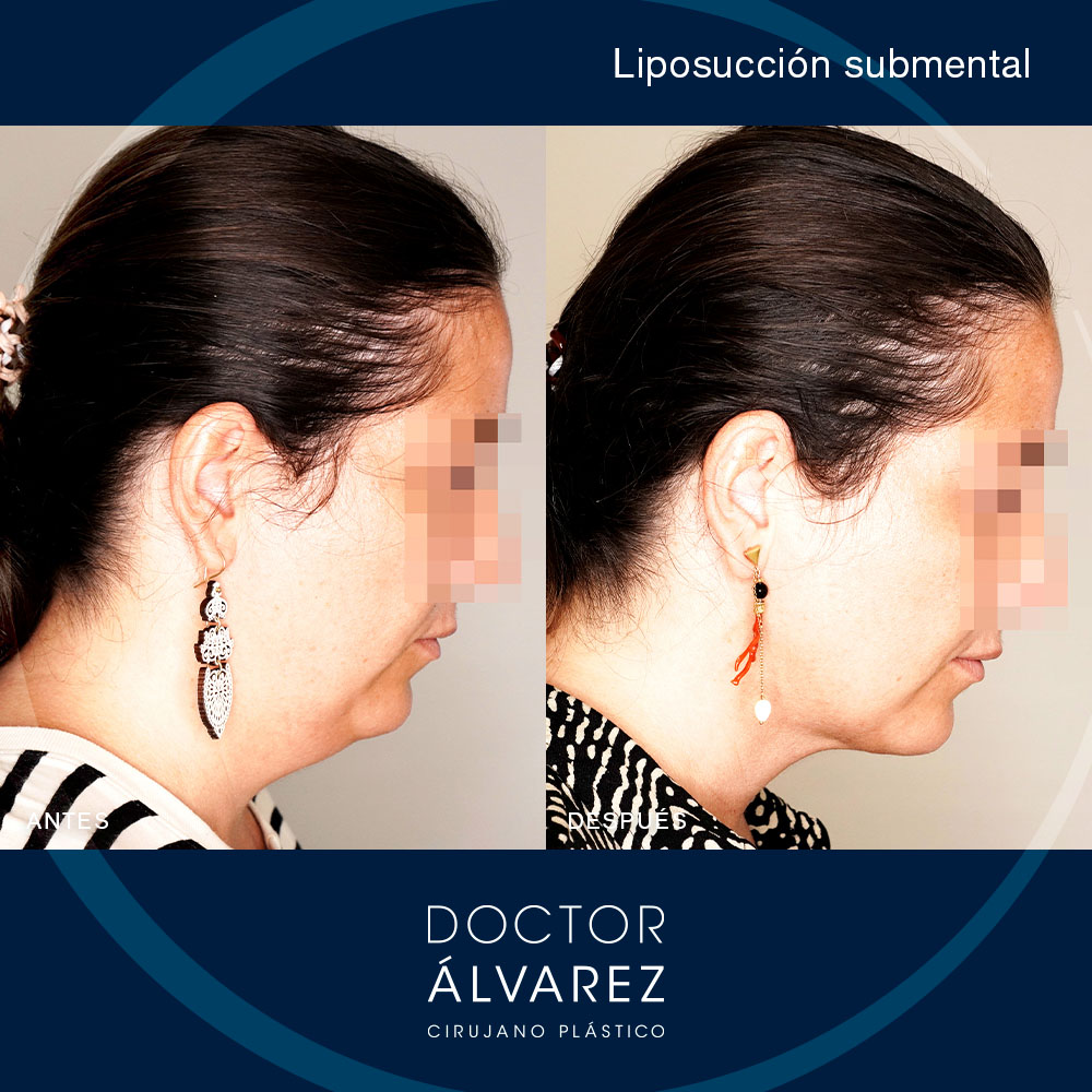 https://cirugiaesteticaplastica.es/caso-de-liposuccion-submental/