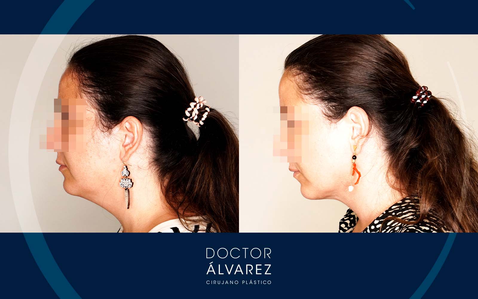 Caso de Liposucción Submental