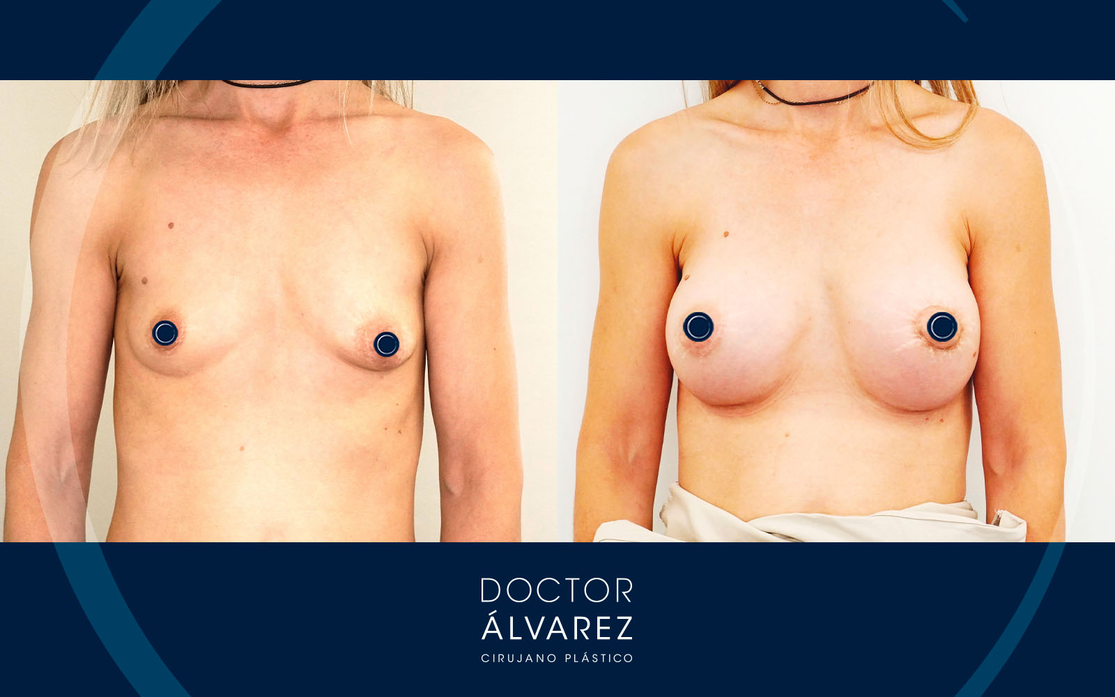 Caso de Mastopexia Periareolar