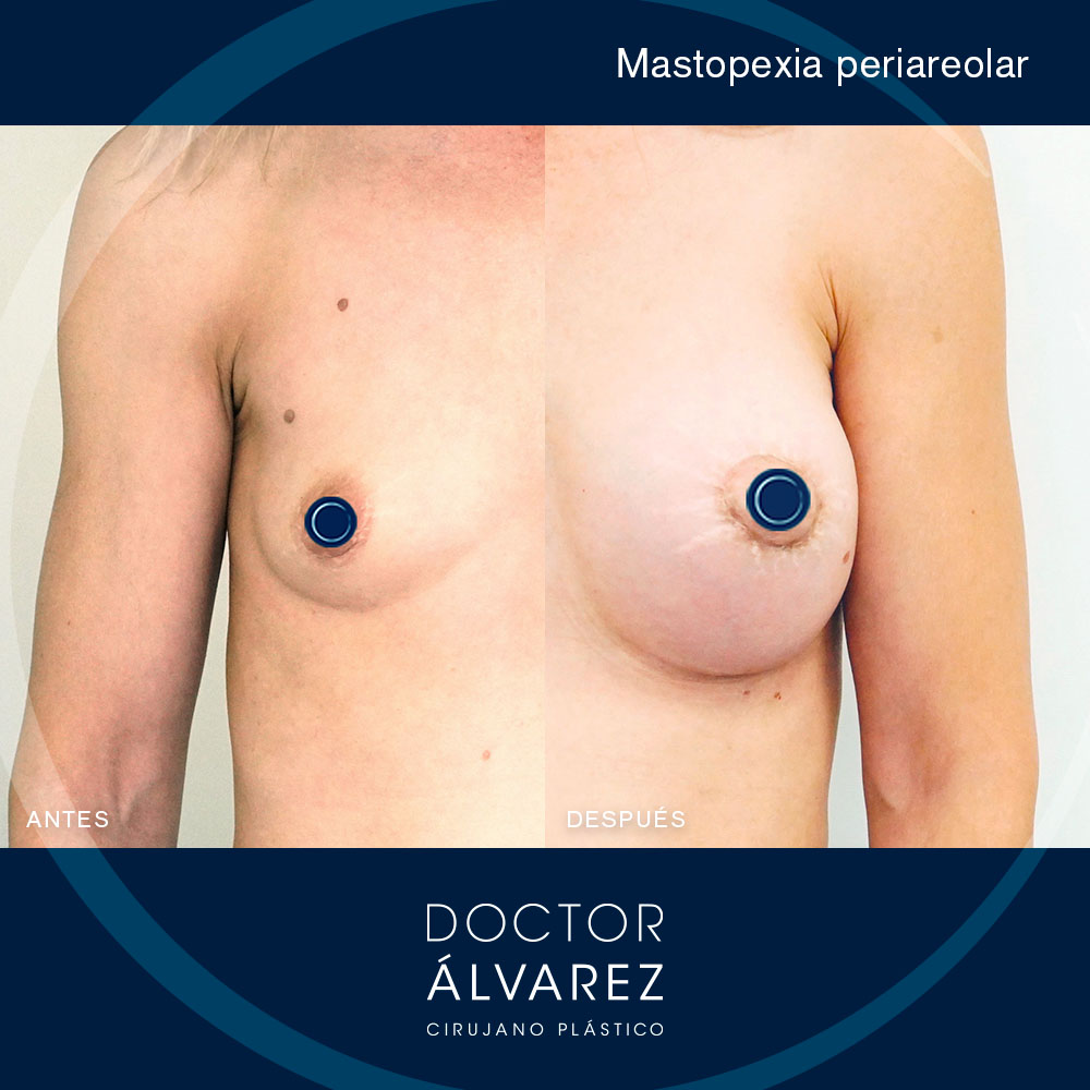 https://cirugiaesteticaplastica.es/caso-de-mastopexia-periareolar/