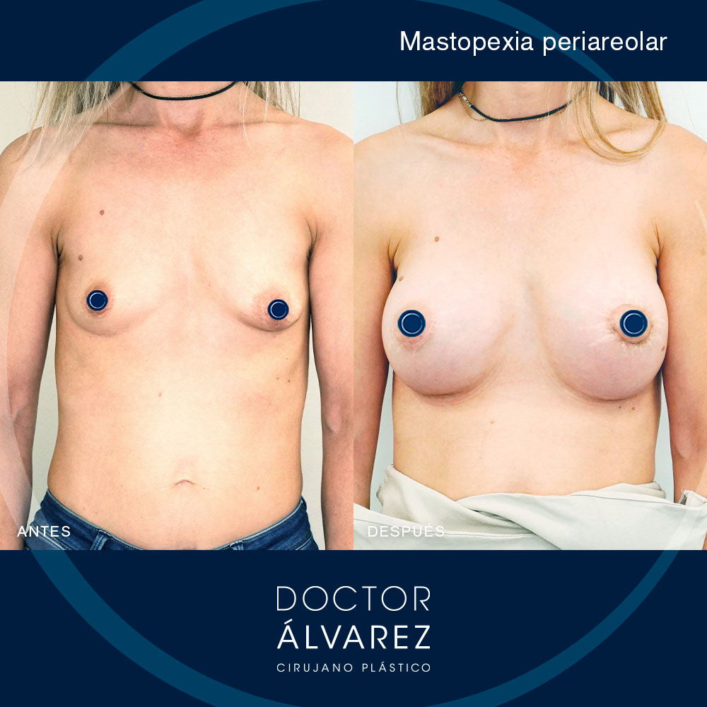 https://cirugiaesteticaplastica.es/caso-de-mastopexia-periareolar/