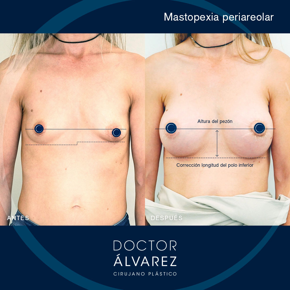 https://cirugiaesteticaplastica.es/caso-de-mastopexia-periareolar/