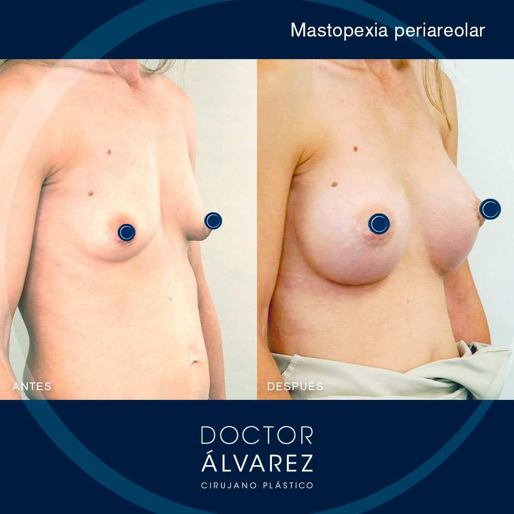 https://cirugiaesteticaplastica.es/caso-de-mastopexia-periareolar/