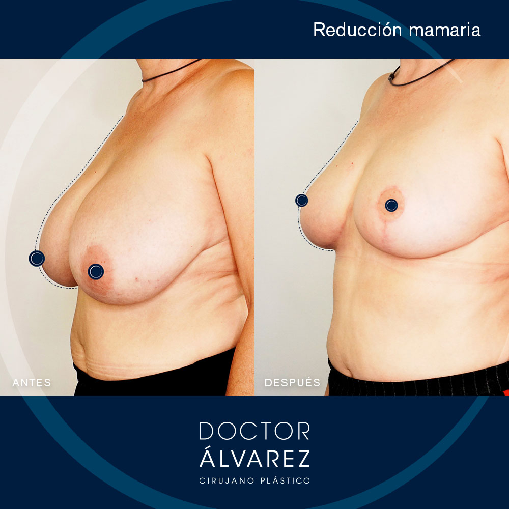 https://cirugiaesteticaplastica.es/caso-de-reduccion-mamaria-890-gramos-menos-en-cada-pecho/