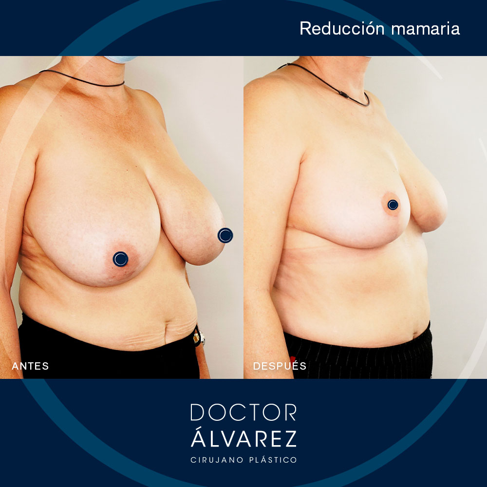 https://cirugiaesteticaplastica.es/caso-de-reduccion-mamaria-890-gramos-menos-en-cada-pecho/