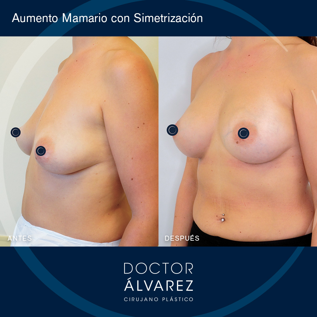 https://cirugiaesteticaplastica.es/caso-de-aumento-de-pecho-con-simetrizacion/