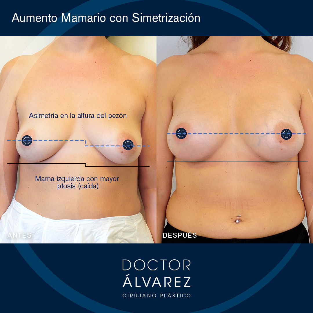 https://cirugiaesteticaplastica.es/caso-de-aumento-de-pecho-con-simetrizacion/
