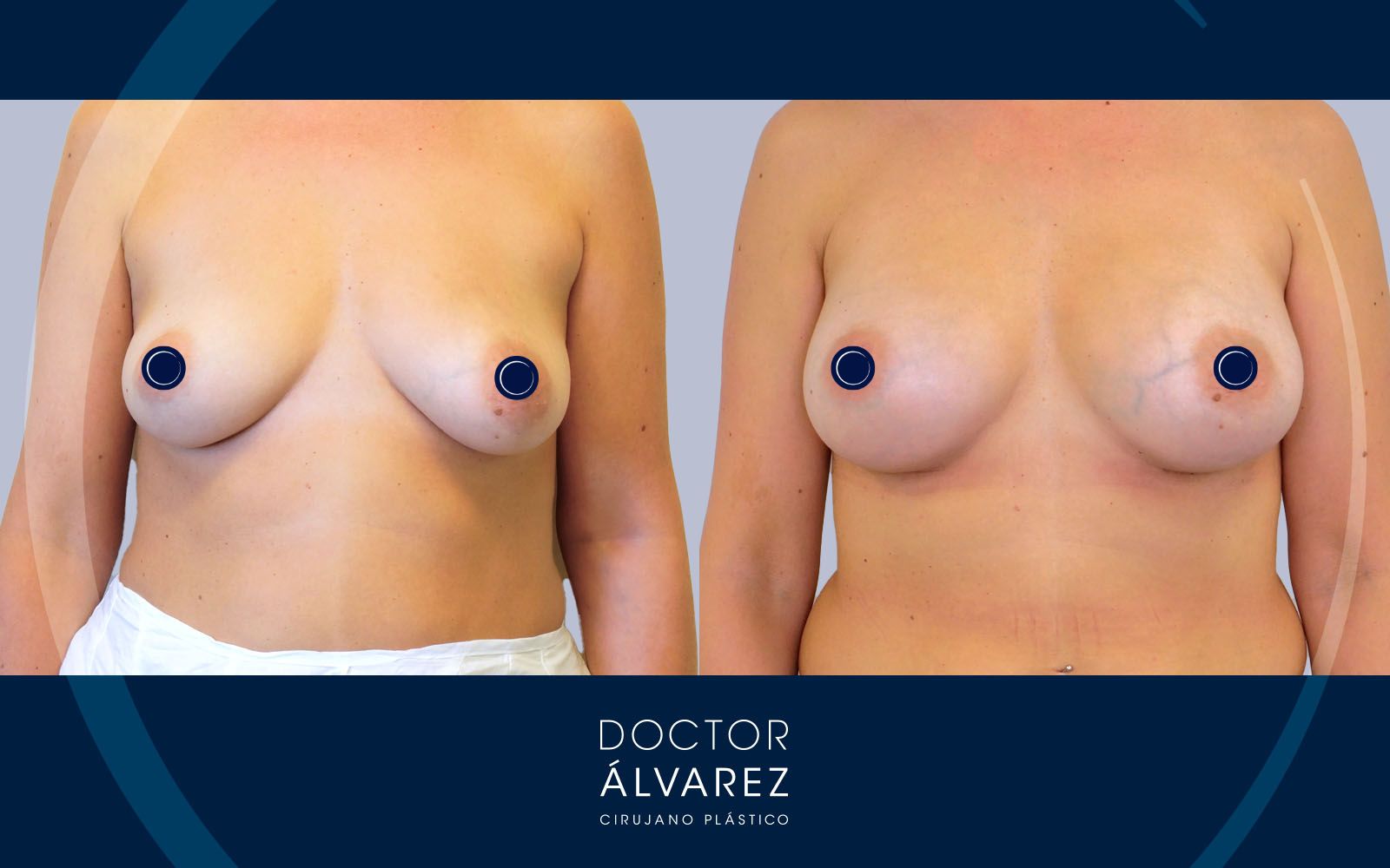Caso de Aumento de Pecho con Simetrización