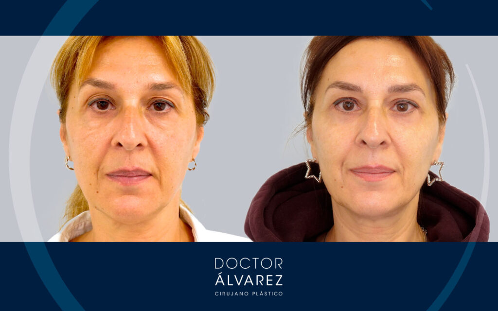 Resultado frontal de una blefaroplastia