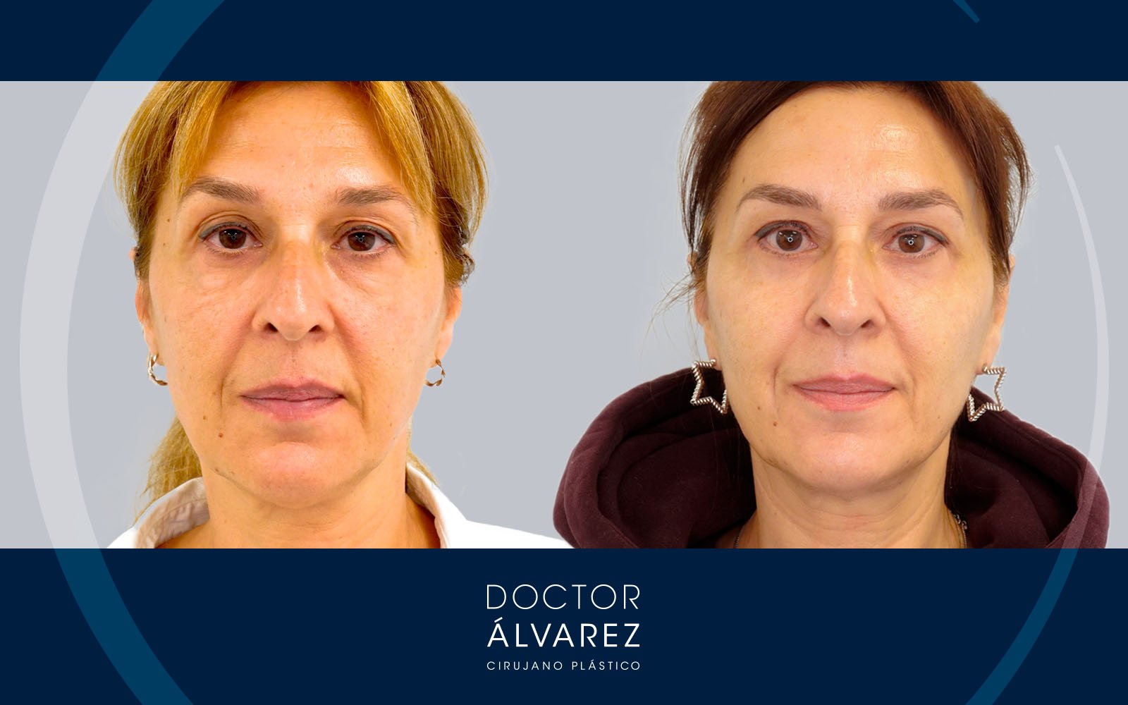 Caso de Blefaroplastia en mujer