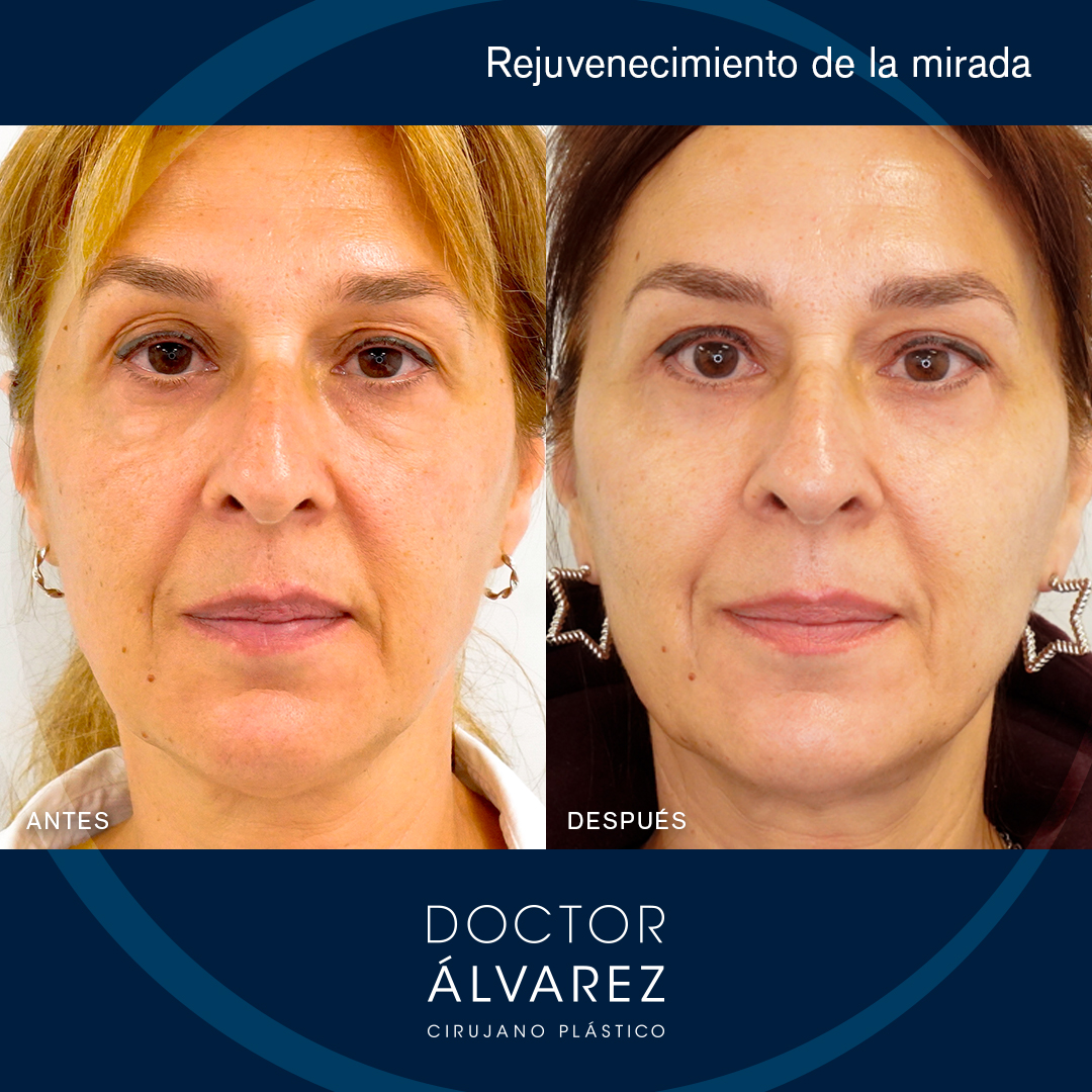 https://cirugiaesteticaplastica.es/caso-de-blefaroplastia-en-mujer/