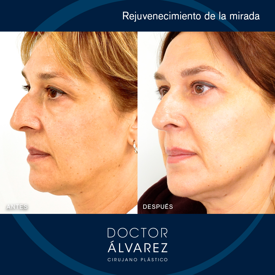 https://cirugiaesteticaplastica.es/caso-de-blefaroplastia-en-mujer/