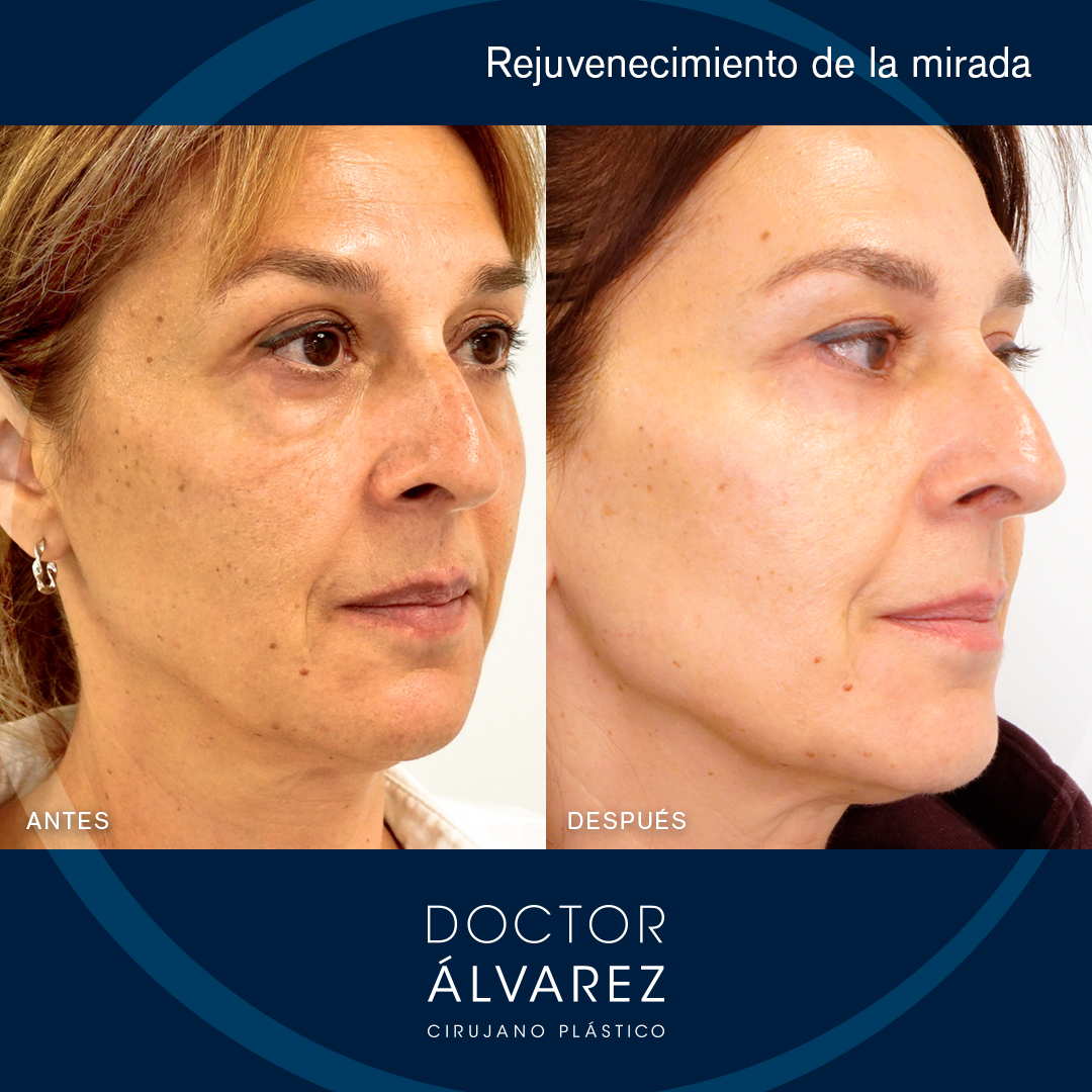 https://cirugiaesteticaplastica.es/caso-de-blefaroplastia-en-mujer/