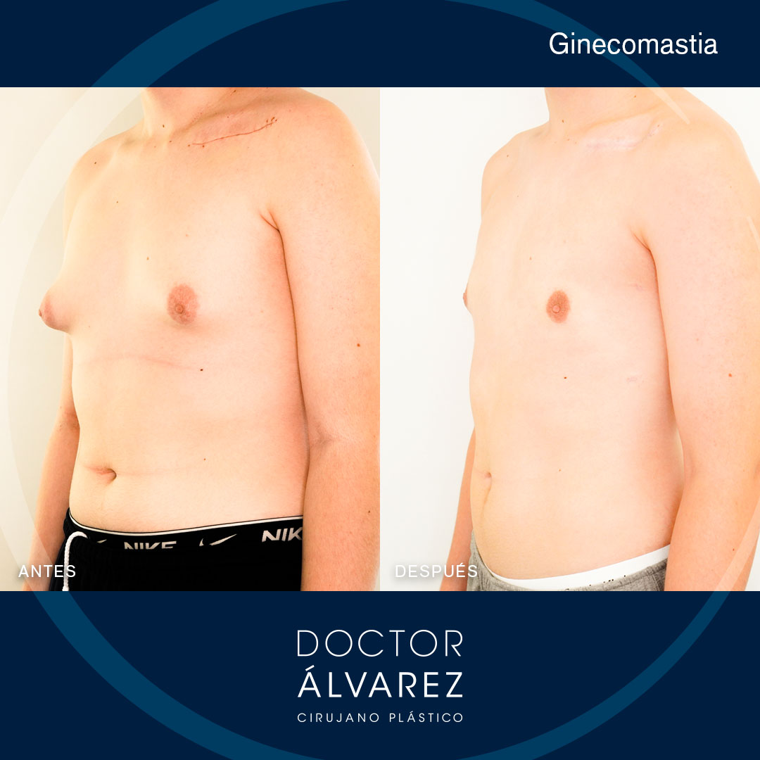https://cirugiaesteticaplastica.es/caso-de-ginecomastia-en-hombre/