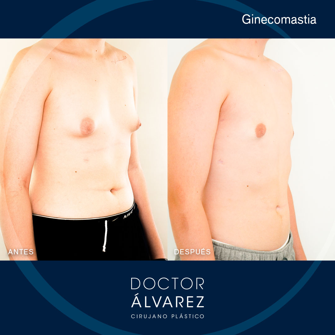 https://cirugiaesteticaplastica.es/caso-de-ginecomastia-en-hombre/