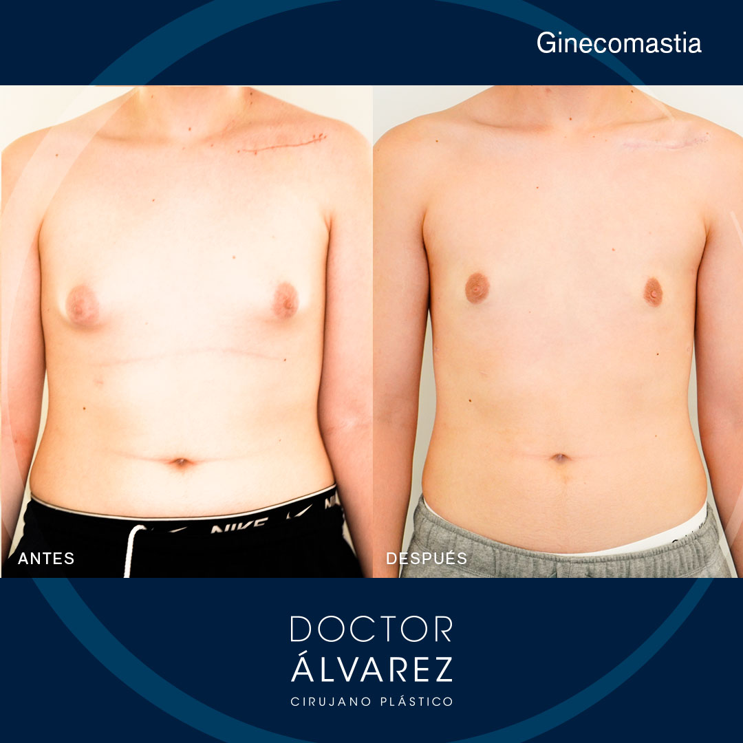 https://cirugiaesteticaplastica.es/caso-de-ginecomastia-en-hombre/