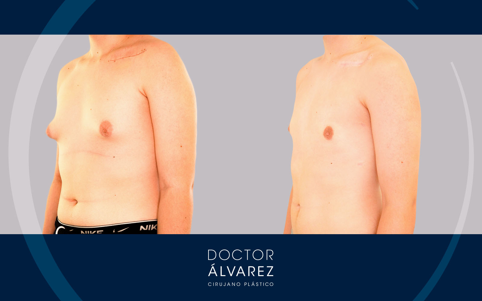 Caso de Ginecomastia en Hombre