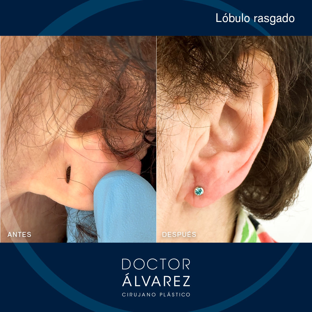 https://cirugiaesteticaplastica.es/caso-de-lobuloplastia/