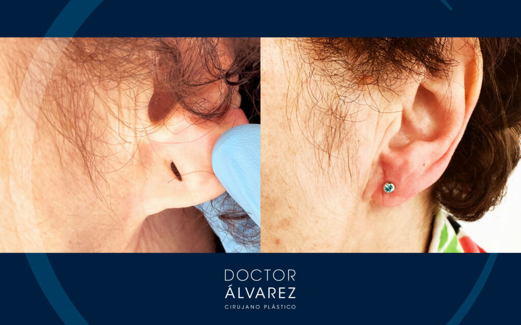 Resultado final de una lobuloplastia