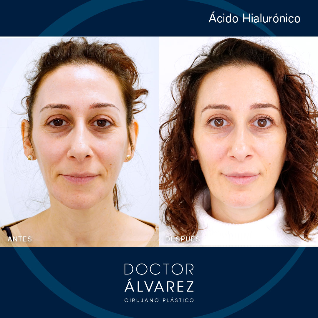 https://cirugiaesteticaplastica.es/caso-de-armonizacion-facial-sin-cirugia/