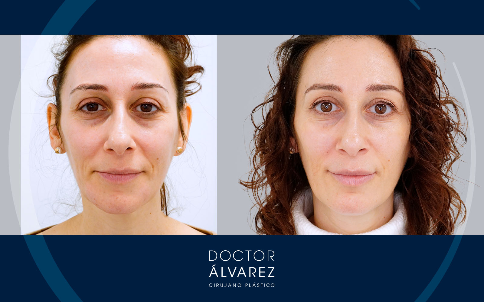 Caso de armonización facial sin cirugía