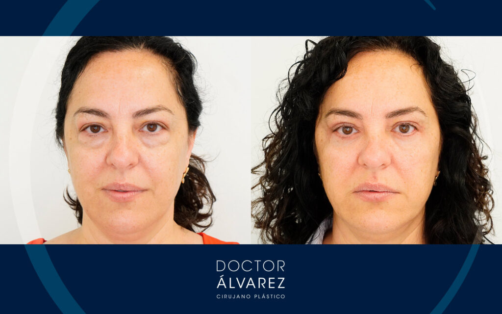 Resultado de una blefaroplastia superior e inferior