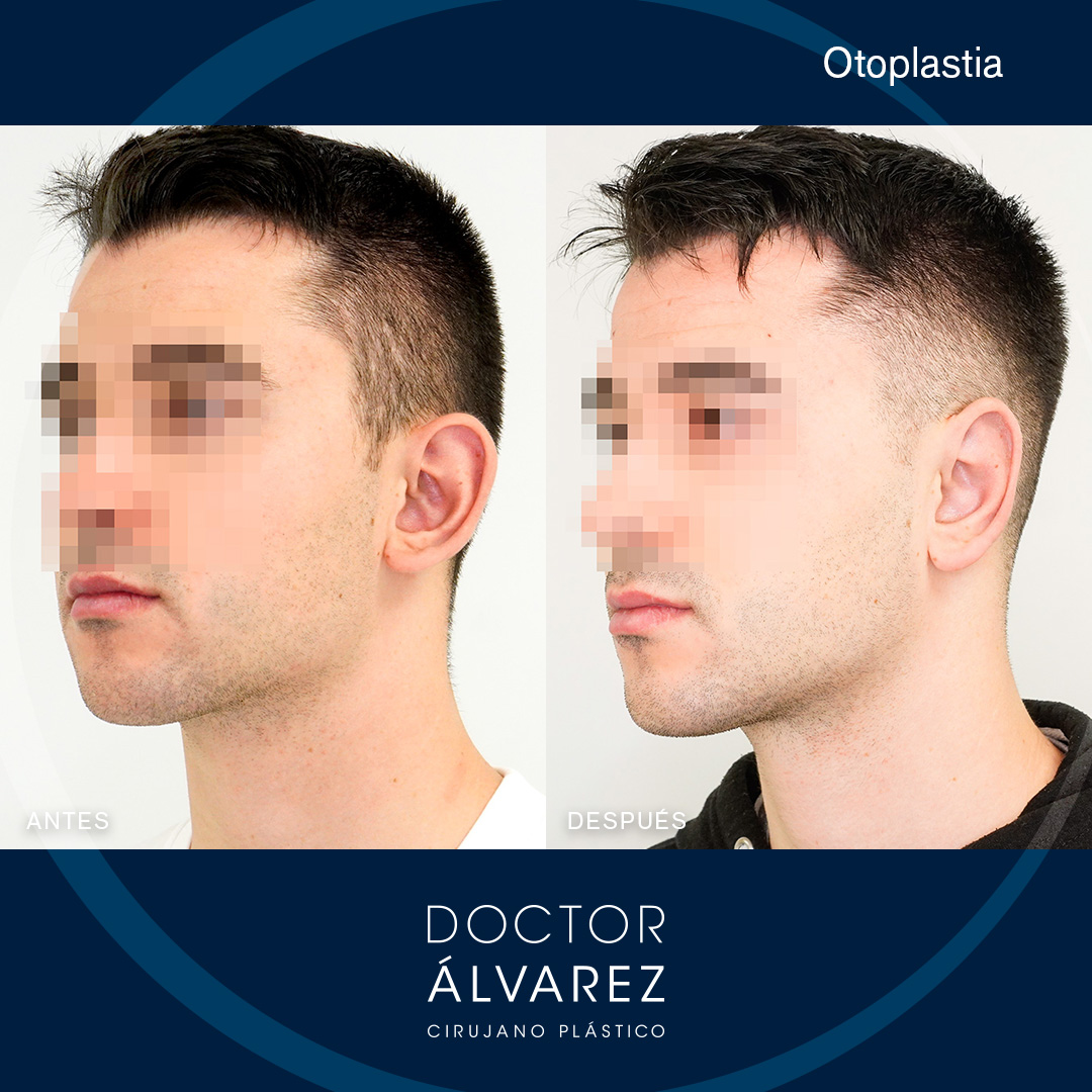 https://cirugiaesteticaplastica.es/caso-de-otoplastia-con-un-lobulo-muy-proyectado/