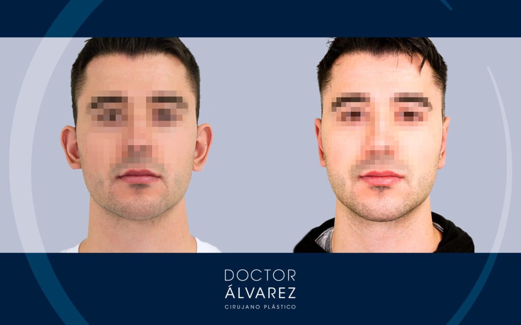Resultado de una otoplastia