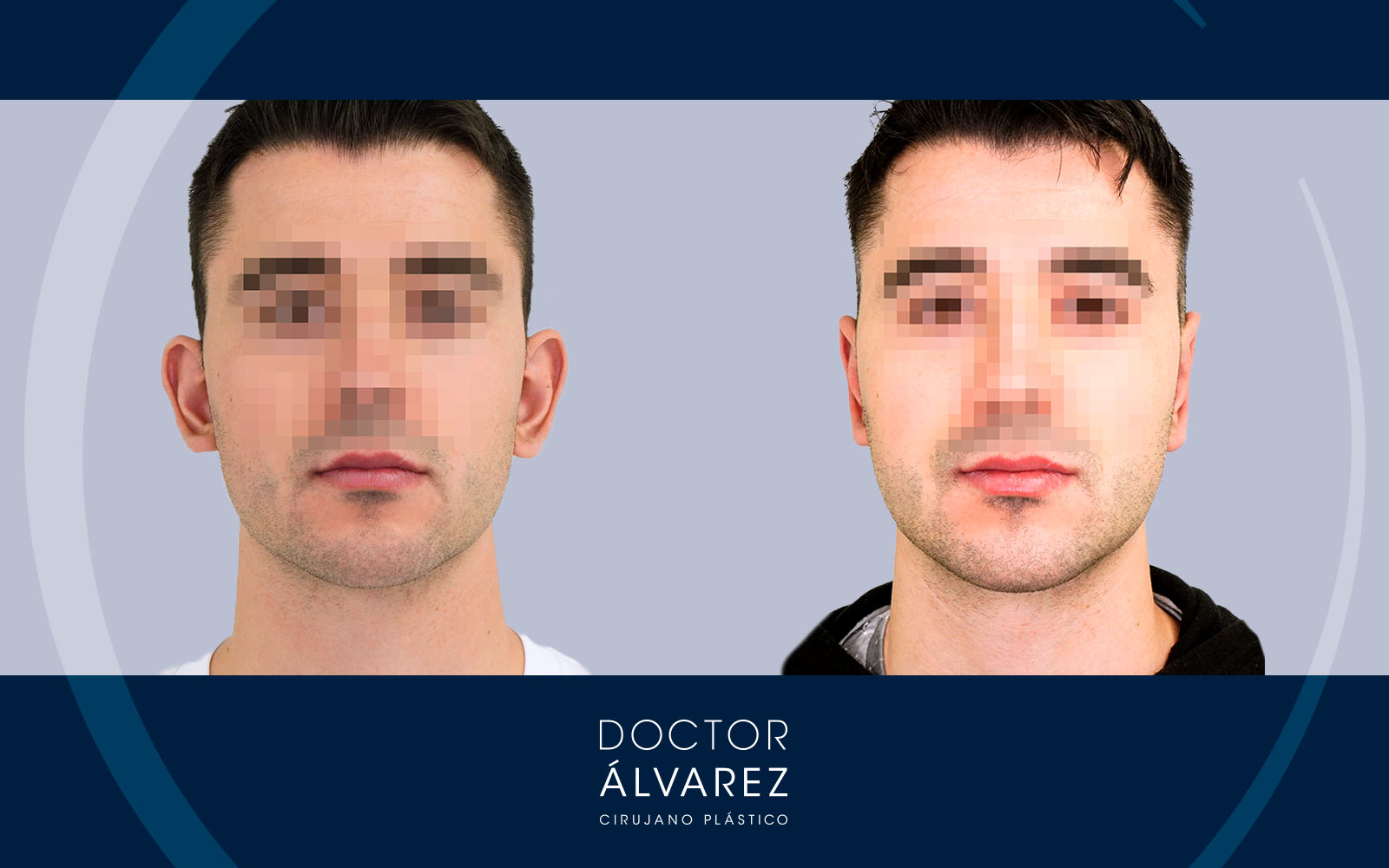 Caso de Otoplastia con un lóbulo muy proyectado