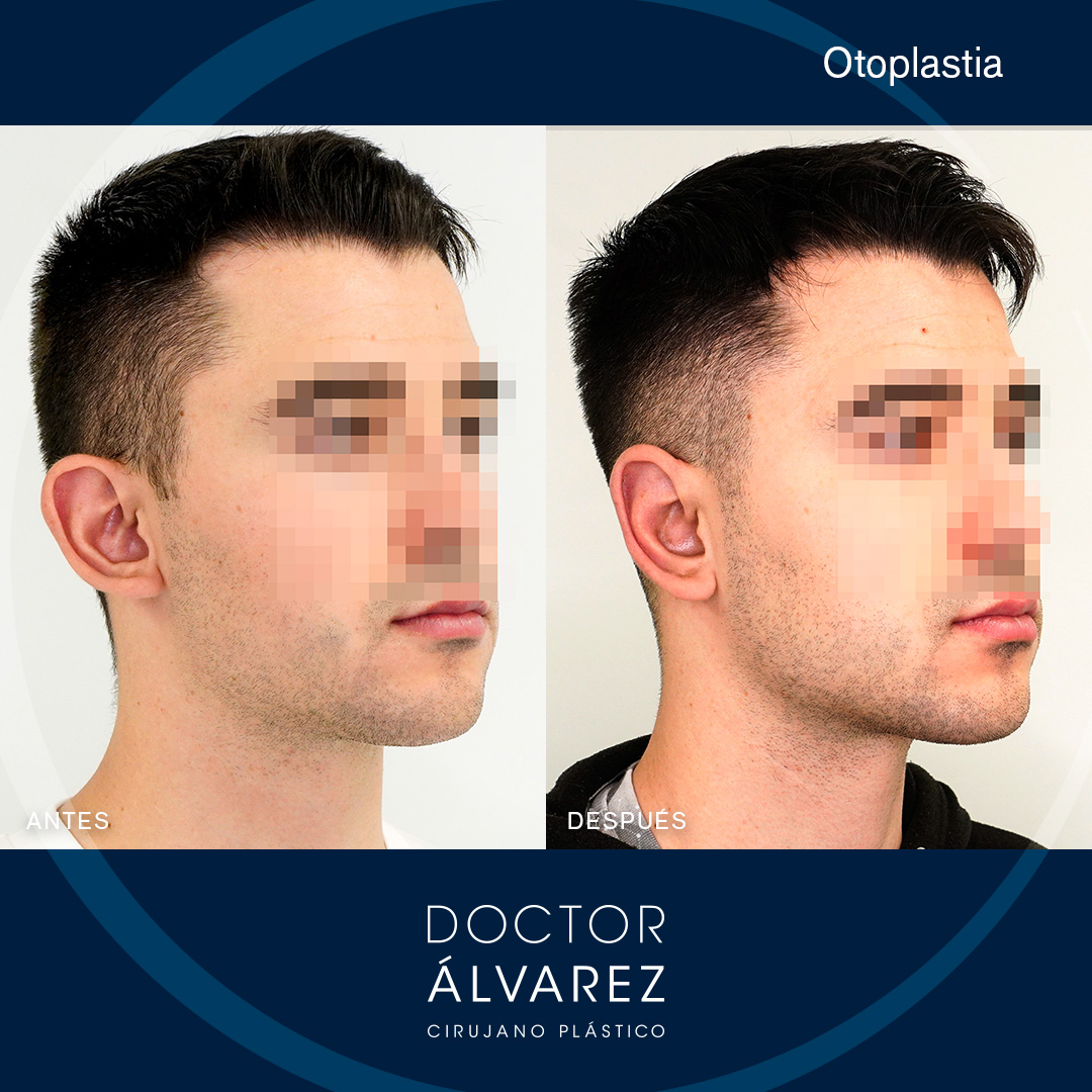 https://cirugiaesteticaplastica.es/caso-de-otoplastia-con-un-lobulo-muy-proyectado/