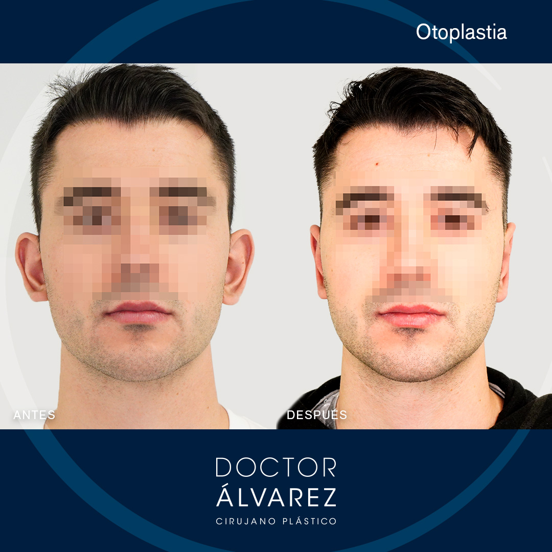 https://cirugiaesteticaplastica.es/caso-de-otoplastia-con-un-lobulo-muy-proyectado/