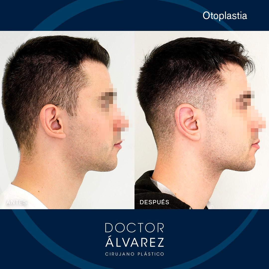 https://cirugiaesteticaplastica.es/caso-de-otoplastia-con-un-lobulo-muy-proyectado/