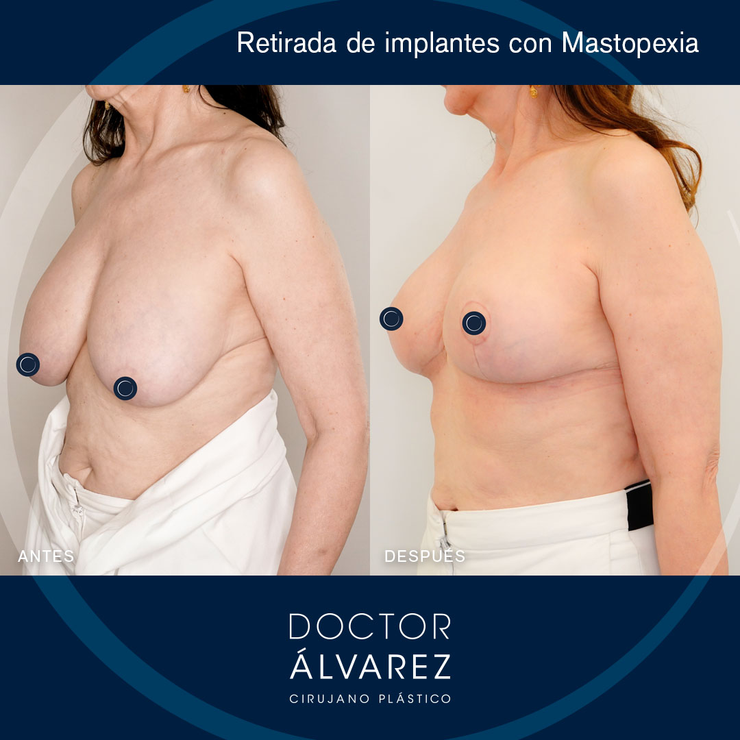 https://cirugiaesteticaplastica.es/retirada-de-implantes-rotos/