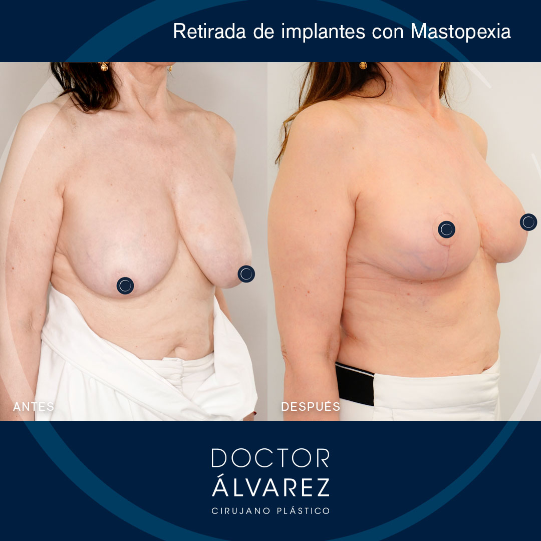 https://cirugiaesteticaplastica.es/retirada-de-implantes-rotos/