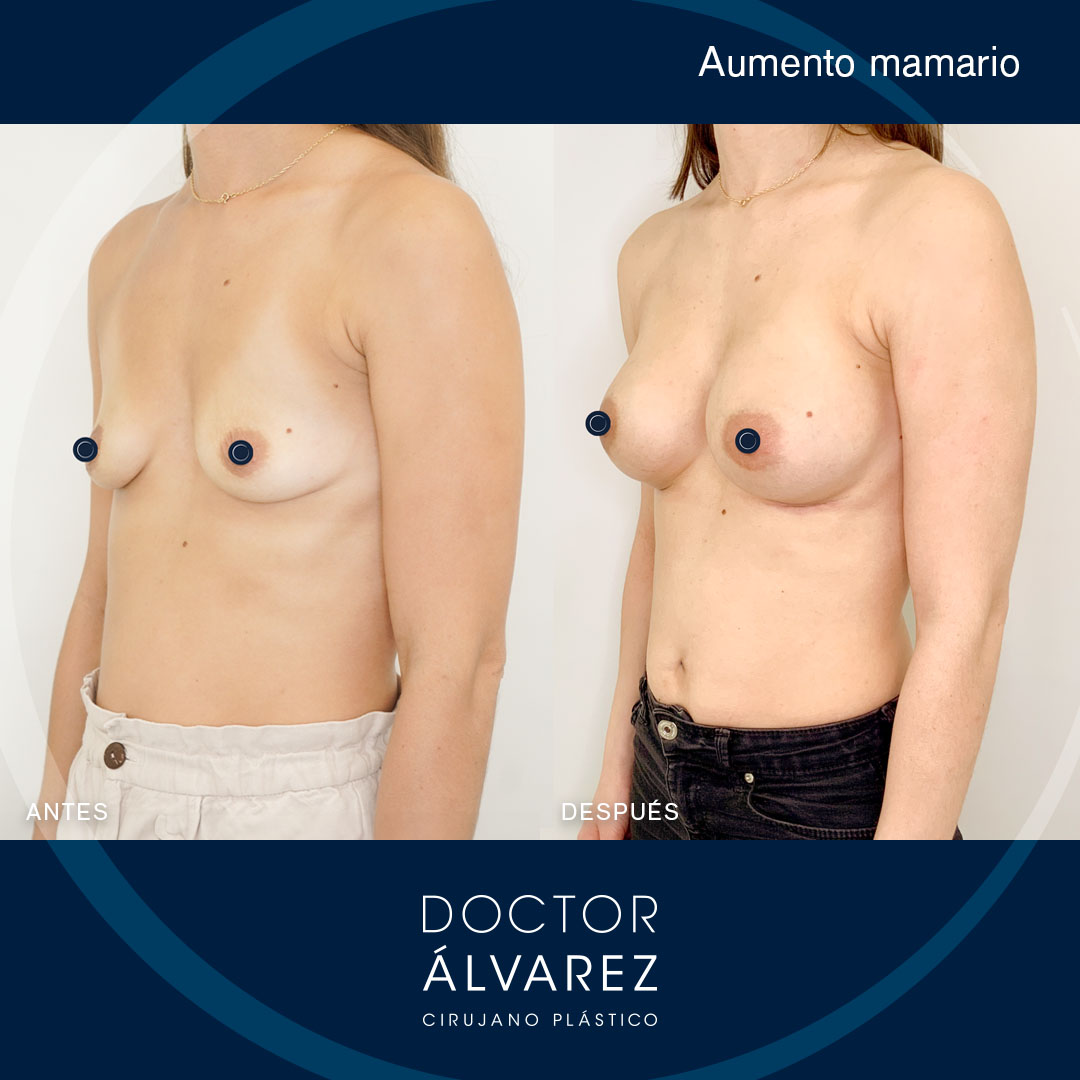 https://cirugiaesteticaplastica.es/aumento-mamario-con-resultado-natural/