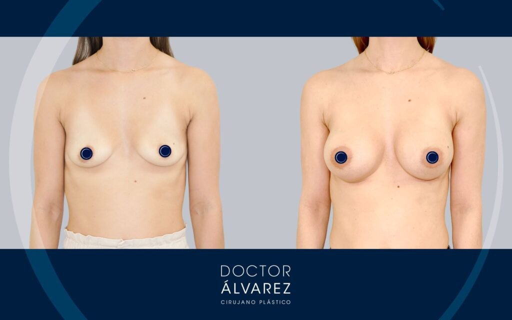 resultado de aumento mamario a los 4 meses