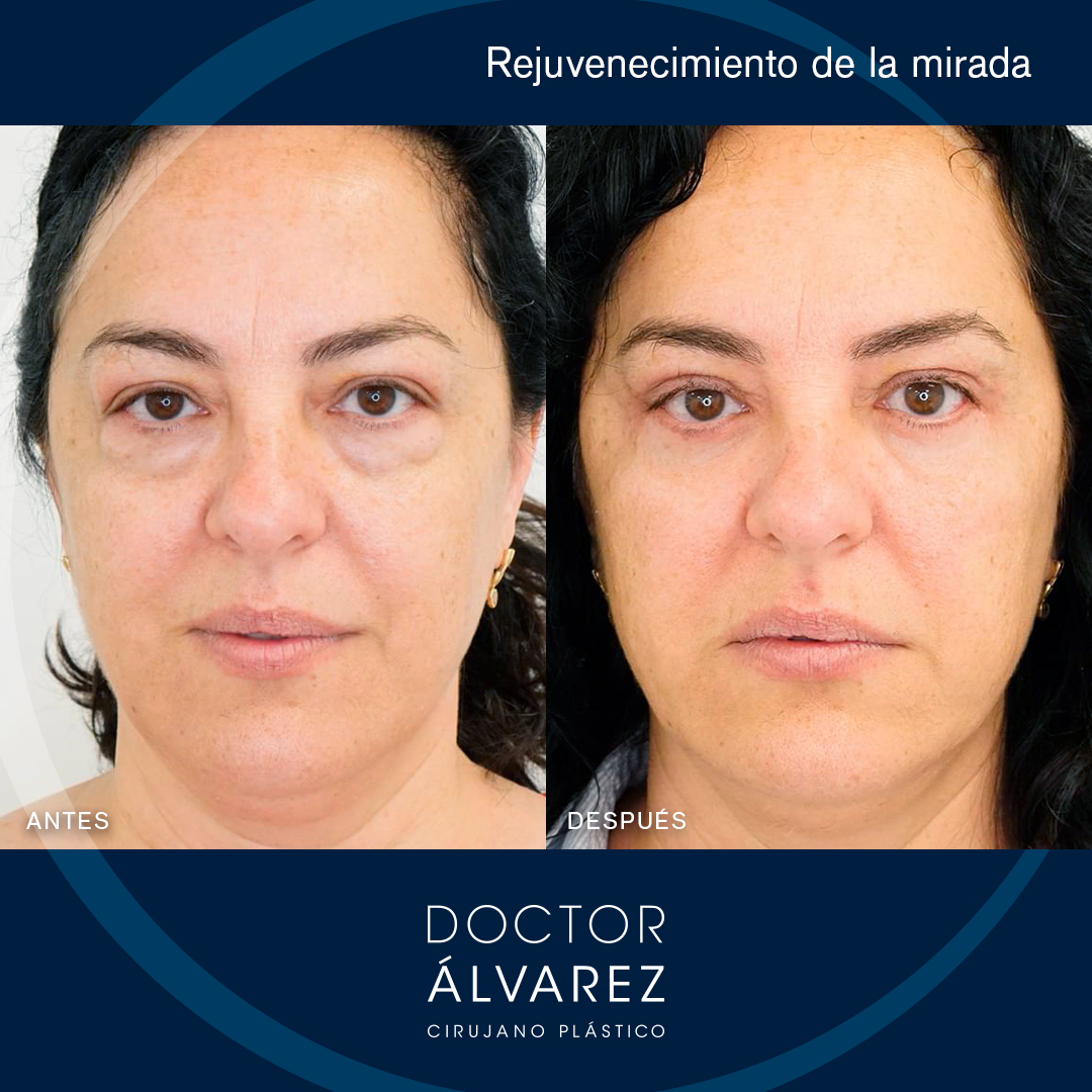 https://cirugiaesteticaplastica.es/caso-de-blefaroplastia-rejuvenecimiento-de-la-mirada/