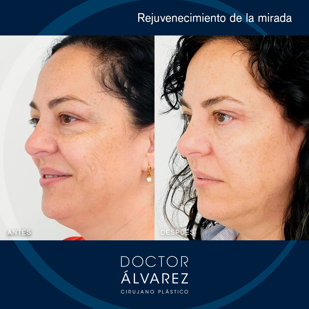 https://cirugiaesteticaplastica.es/caso-de-blefaroplastia-rejuvenecimiento-de-la-mirada/