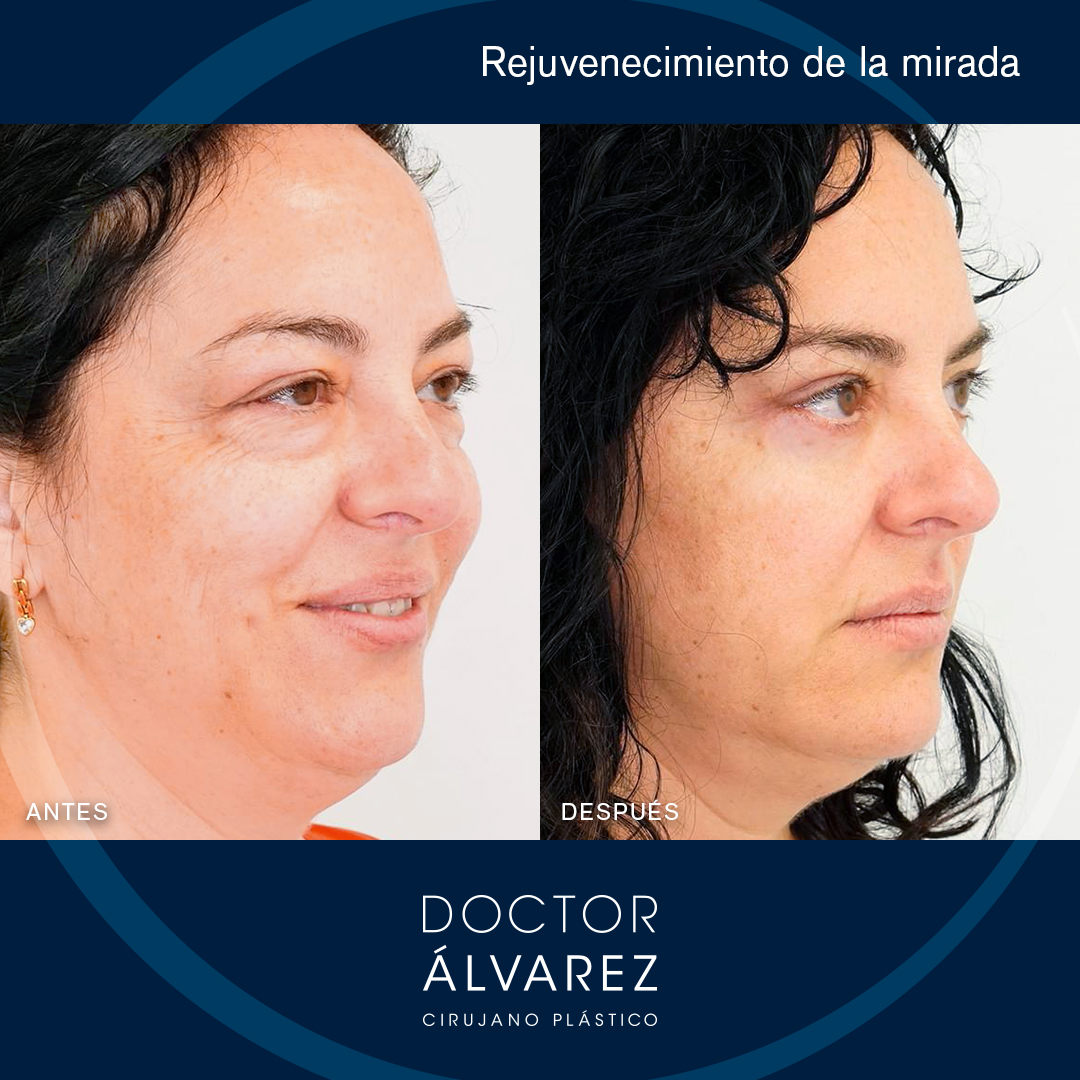 https://cirugiaesteticaplastica.es/caso-de-blefaroplastia-rejuvenecimiento-de-la-mirada/