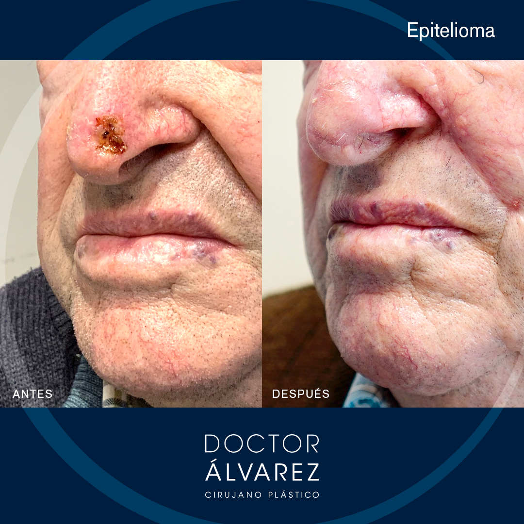 https://cirugiaesteticaplastica.es/caso-de-reconstruccion-tras-cancer-de-piel/