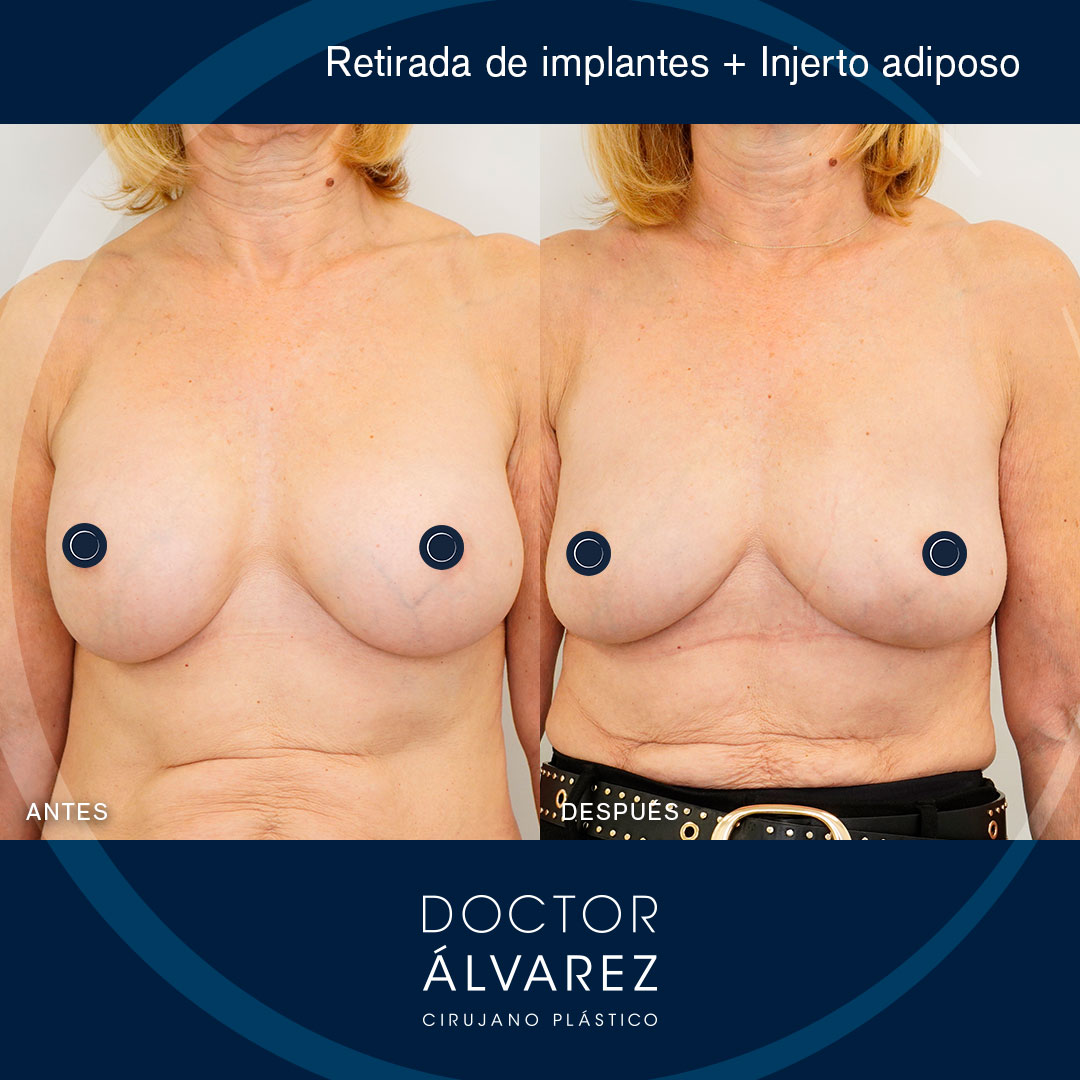 https://cirugiaesteticaplastica.es/retirada-de-implantes-y-lipoinjerto/