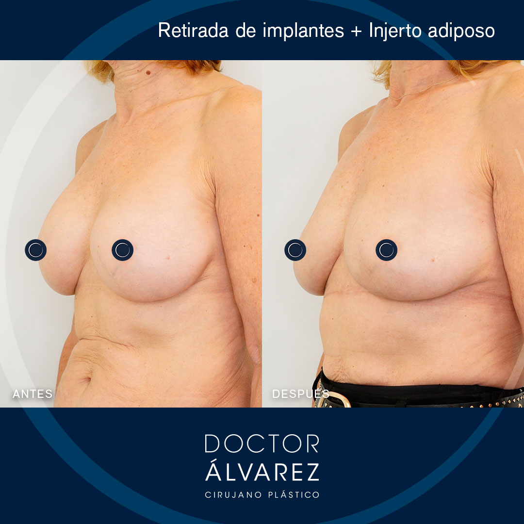 https://cirugiaesteticaplastica.es/retirada-de-implantes-y-lipoinjerto/