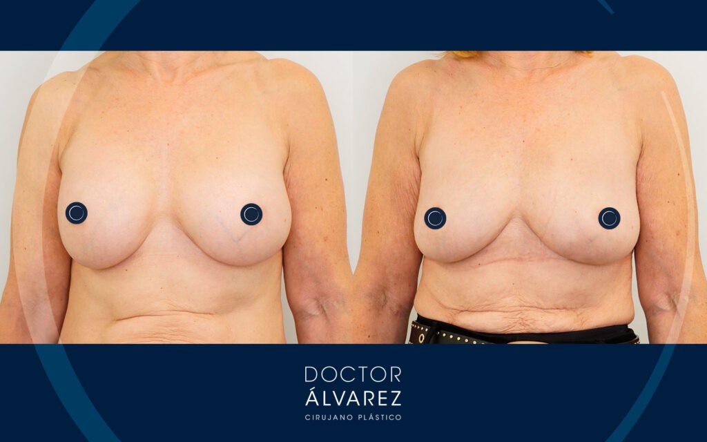 Resultado final tras una retirada de implantes y lipoinjerto