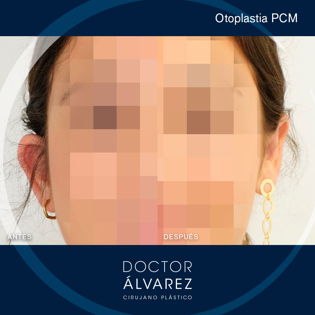 https://cirugiaesteticaplastica.es/otoplastia-planificacion-personalizada-para-un-resultado-natural/