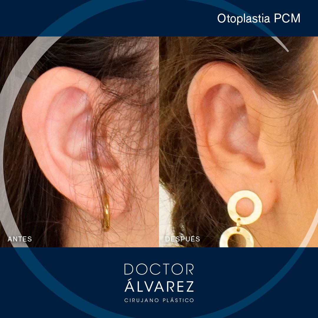 https://cirugiaesteticaplastica.es/otoplastia-planificacion-personalizada-para-un-resultado-natural/