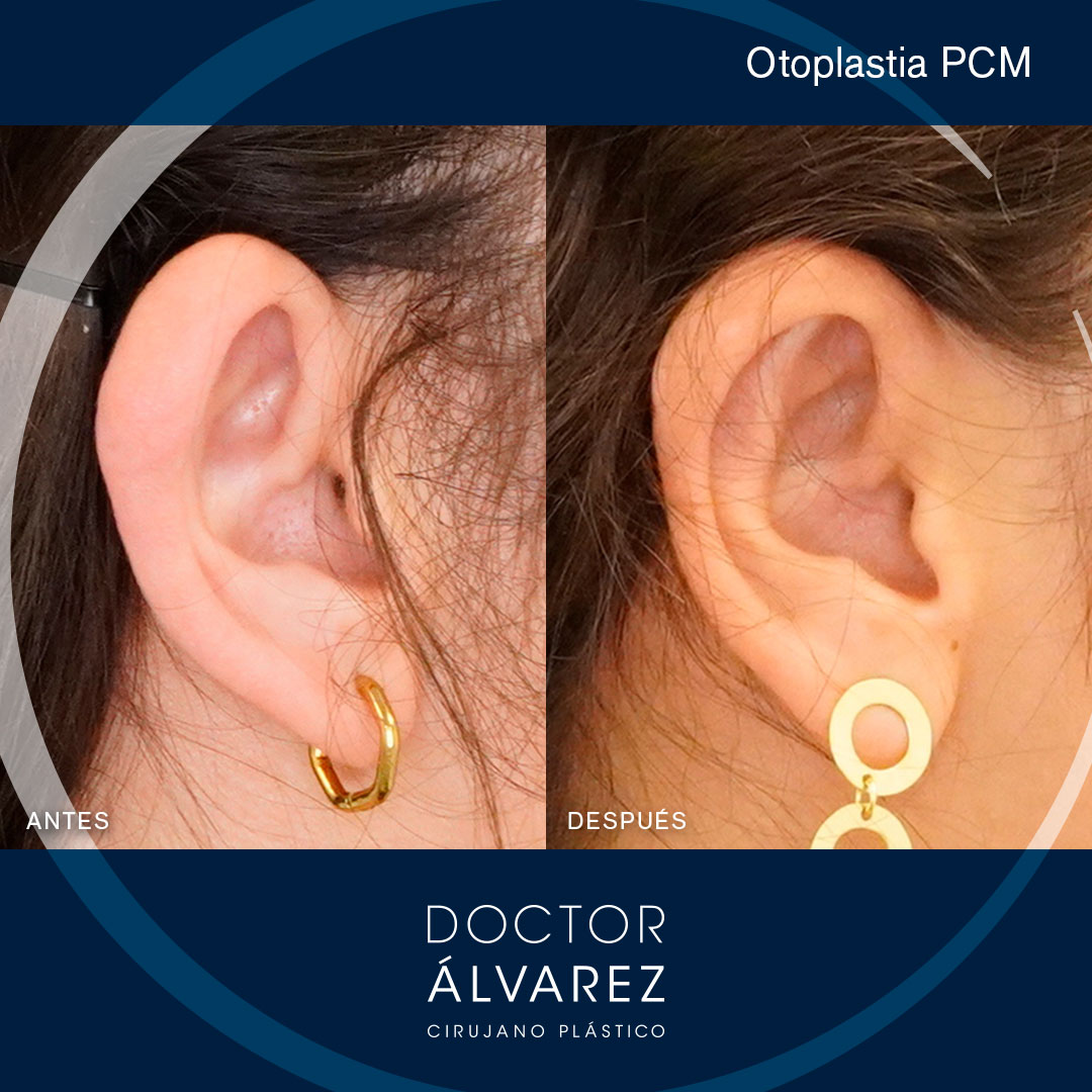 https://cirugiaesteticaplastica.es/otoplastia-planificacion-personalizada-para-un-resultado-natural/