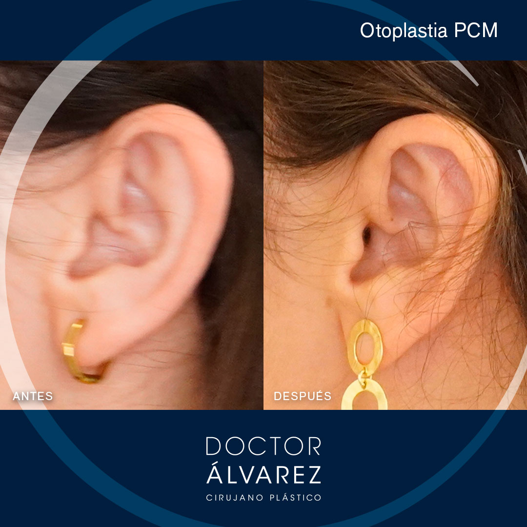https://cirugiaesteticaplastica.es/otoplastia-planificacion-personalizada-para-un-resultado-natural/