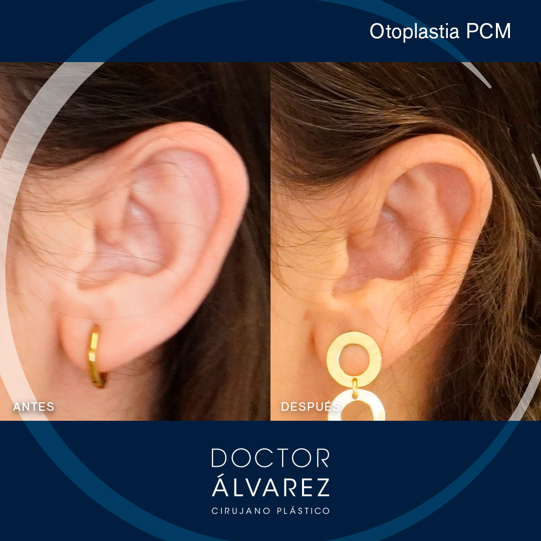 https://cirugiaesteticaplastica.es/otoplastia-planificacion-personalizada-para-un-resultado-natural/