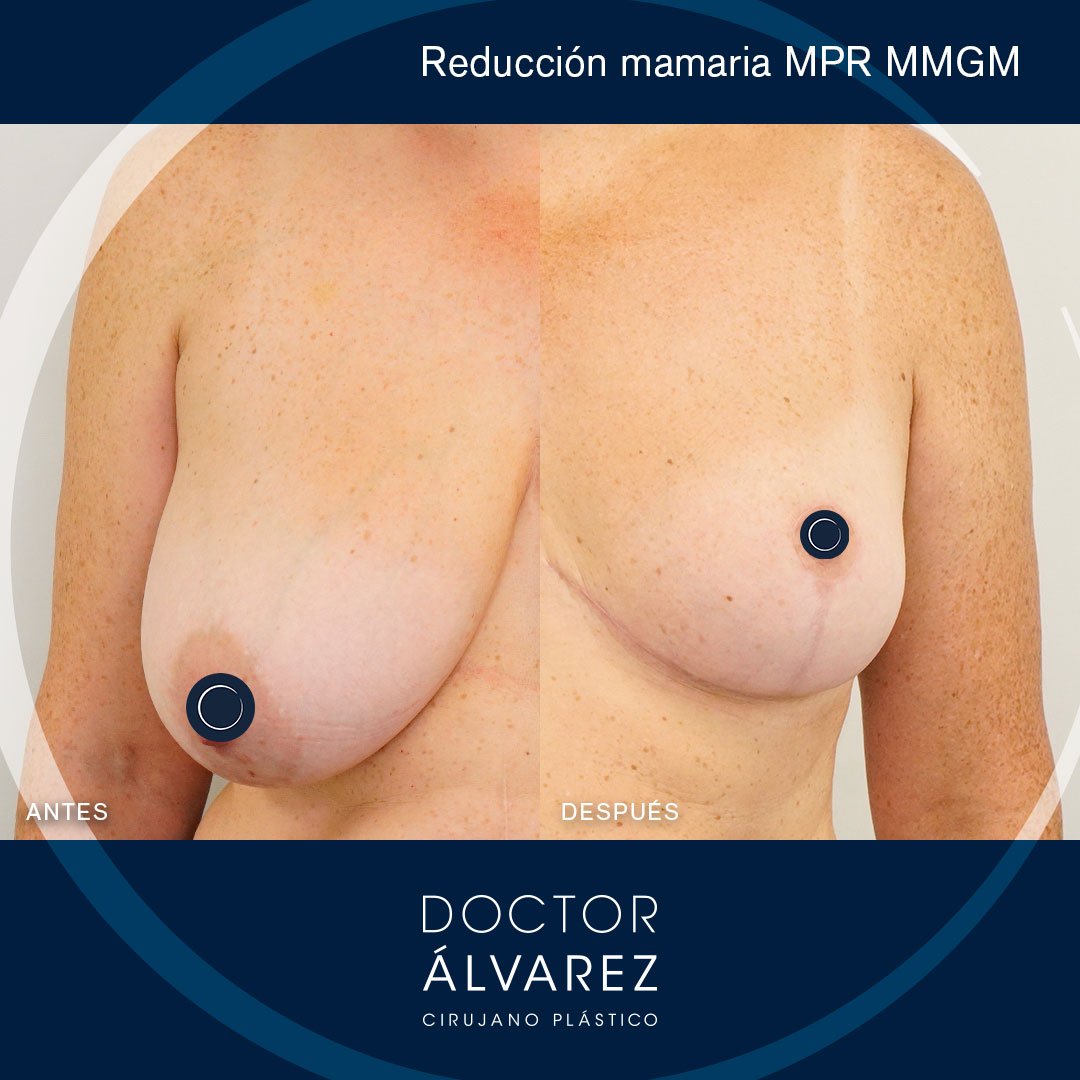 https://cirugiaesteticaplastica.es/reduccion-mamaria-mejora-estetica-y-calidad-de-vida/