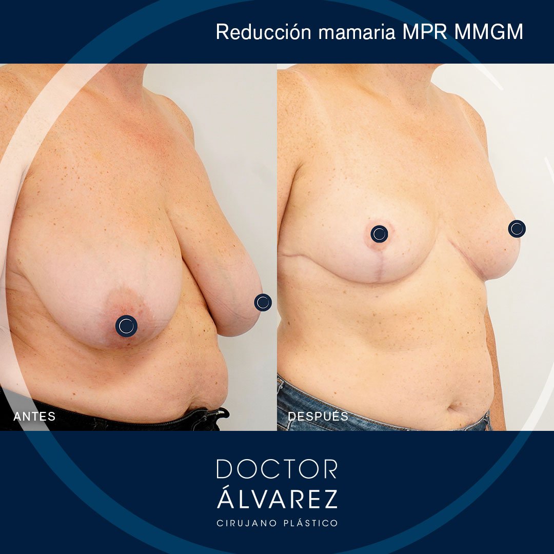 https://cirugiaesteticaplastica.es/reduccion-mamaria-mejora-estetica-y-calidad-de-vida/